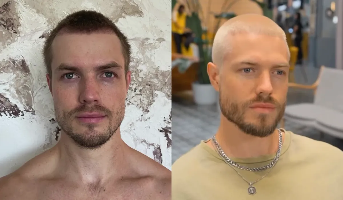 Brett Maverick Hair Transplant