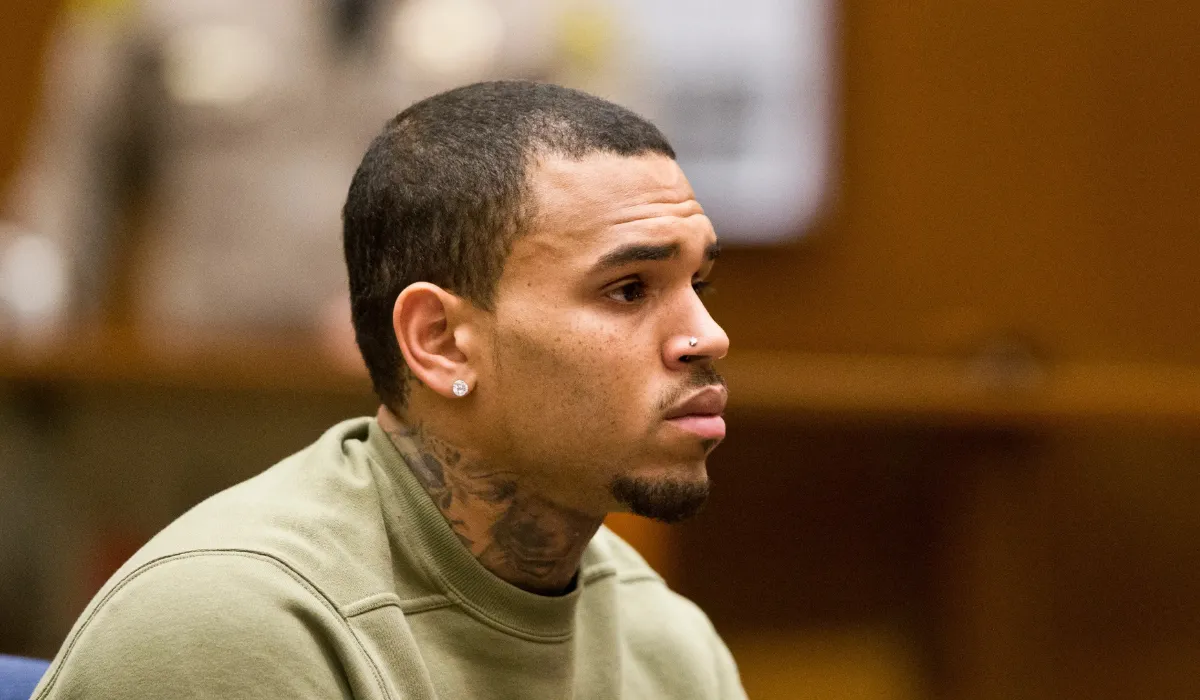 Chris Brown Hair Transplant