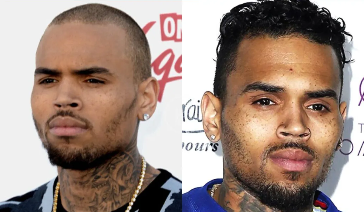 Chris Brown Hair Transplant