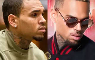 Chris Brown Hair Transplant