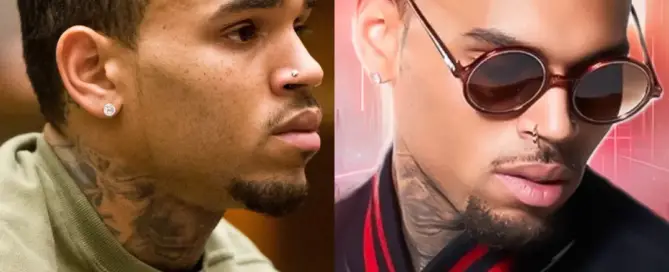 Chris Brown Hair Transplant