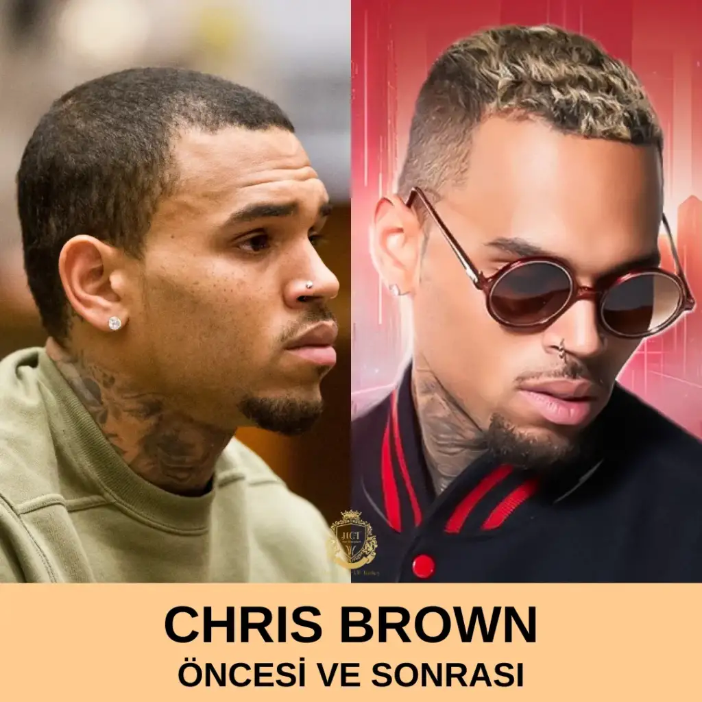 Chris Brown Saç Ekimi