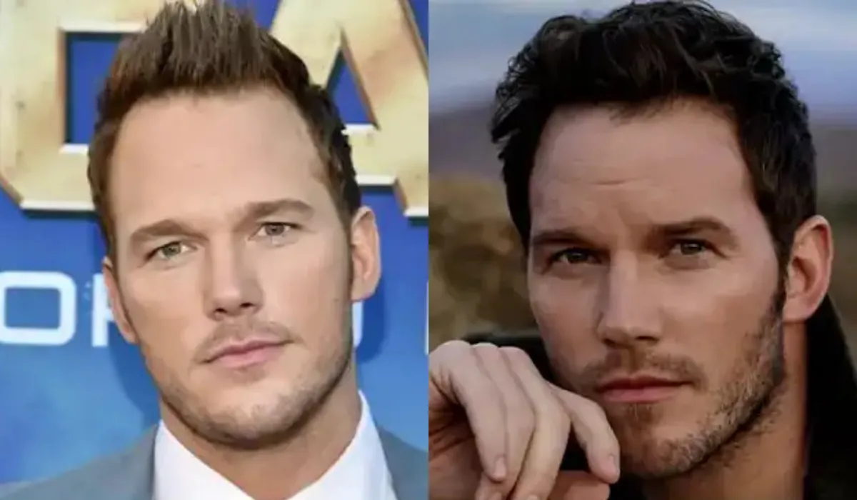 Chris Pratt Hair Transplant