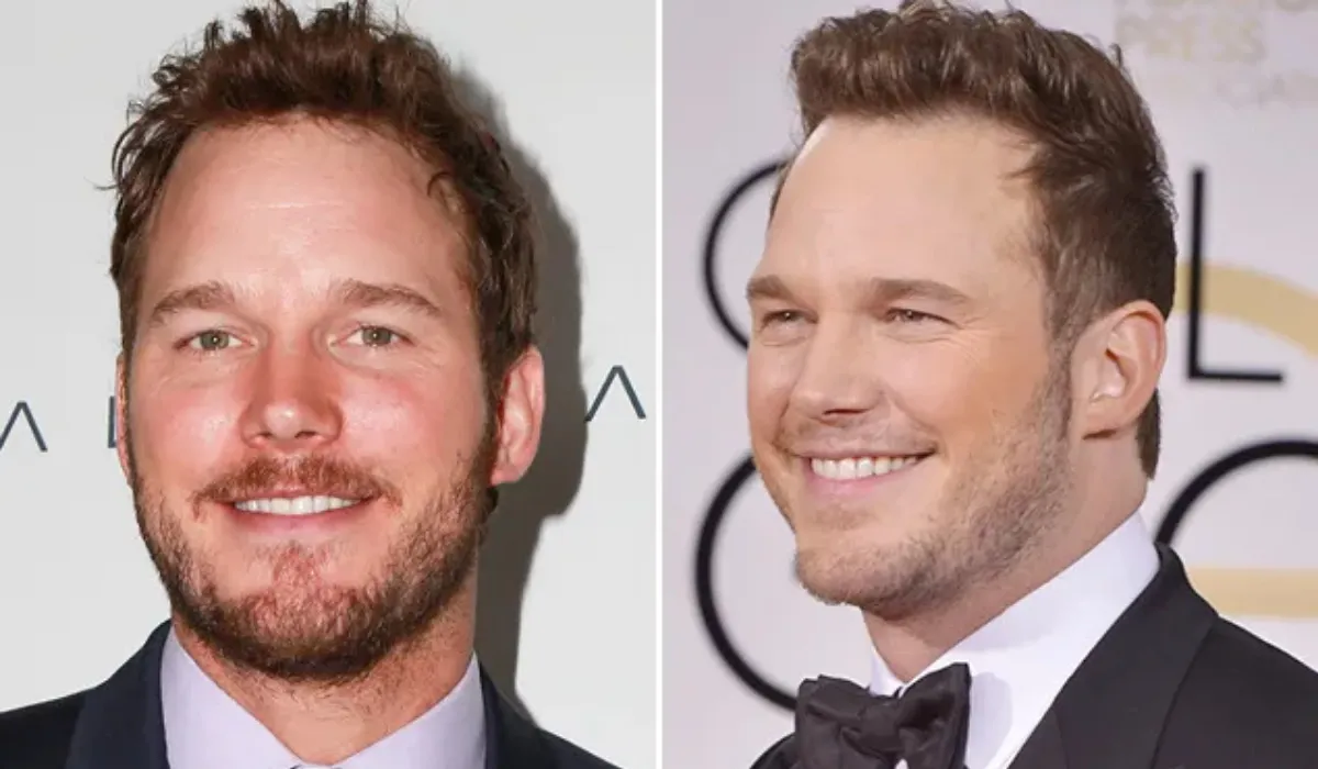 Chris Pratt Hair Transplant