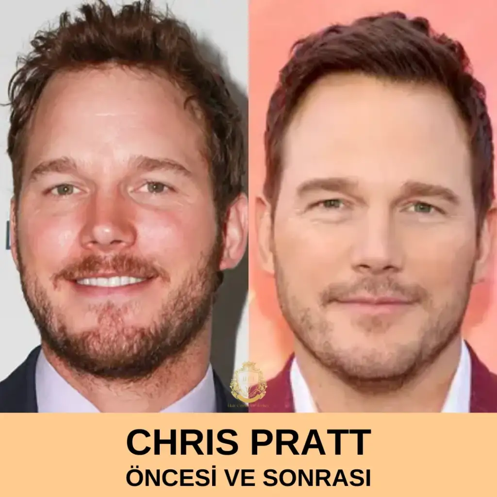 Chris Pratt Hair Transplant