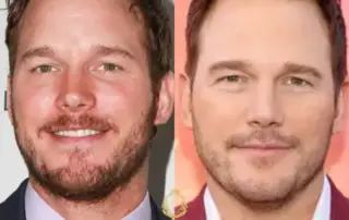 Chris Pratt Hair Transplant