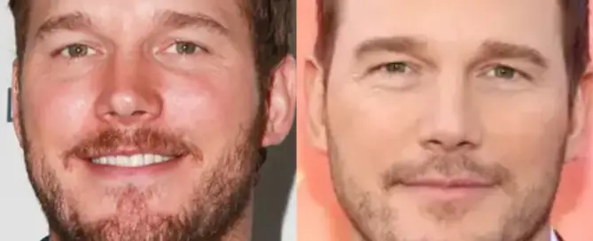 Chris Pratt Hair Transplant