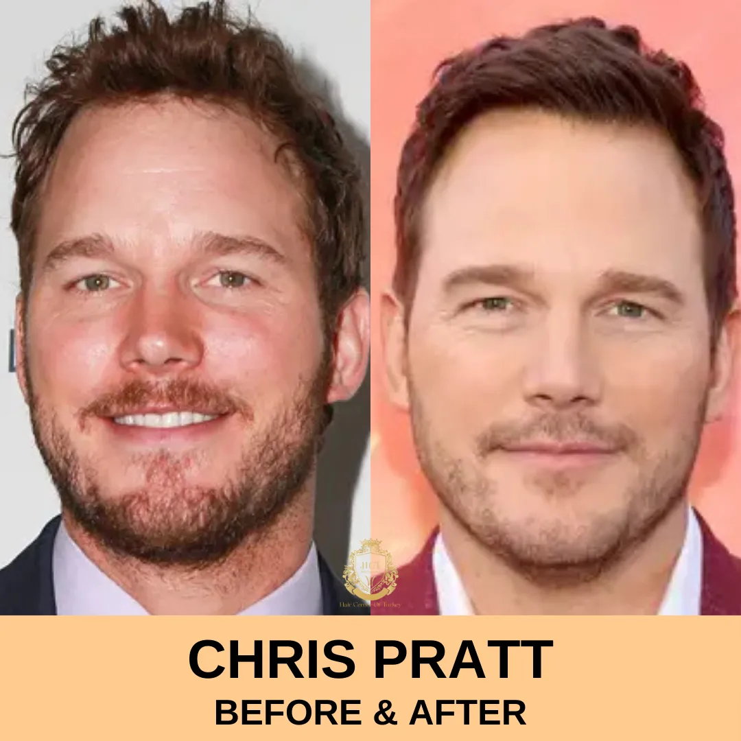 Chris Pratt Hair Transplant