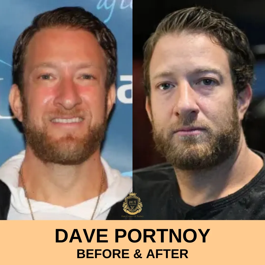 DAVE PORTNOY BEFORE & AFTER