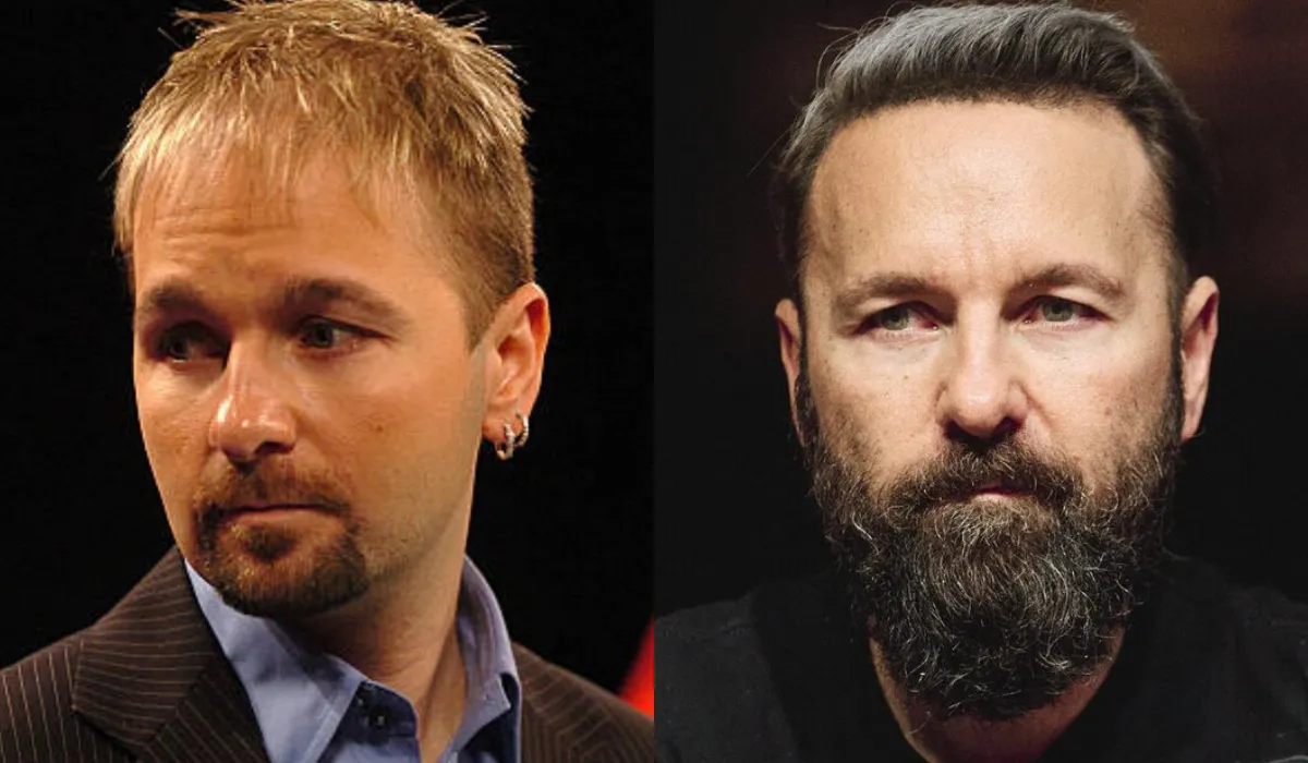 Daniel Negreanu Hair Transplant