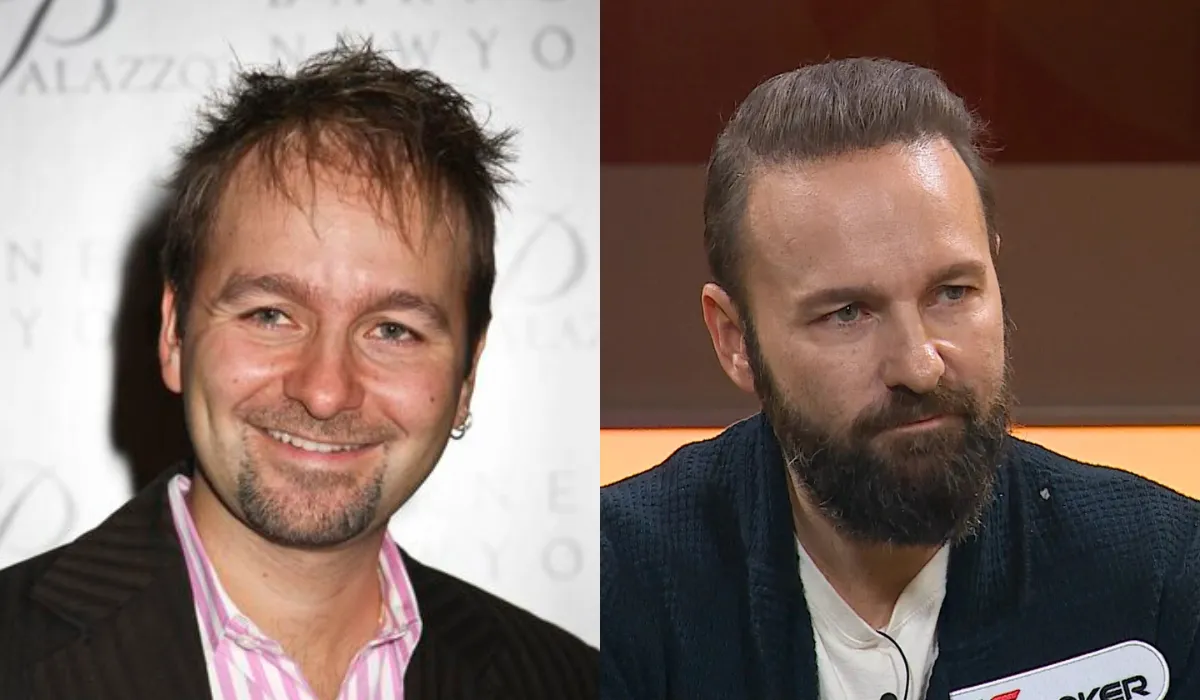 Daniel Negreanu Hair Transplant