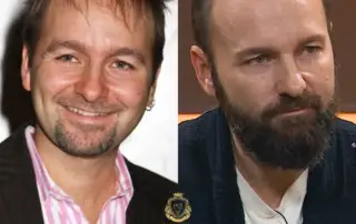 Daniel Negreanu Hair Transplant