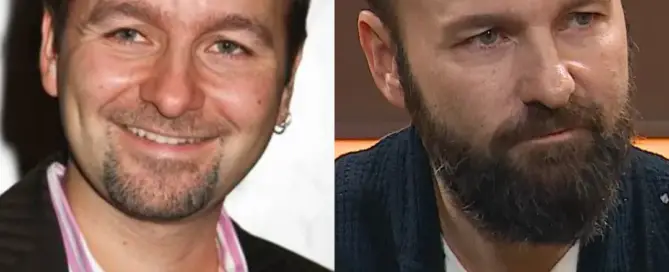 Daniel Negreanu Hair Transplant