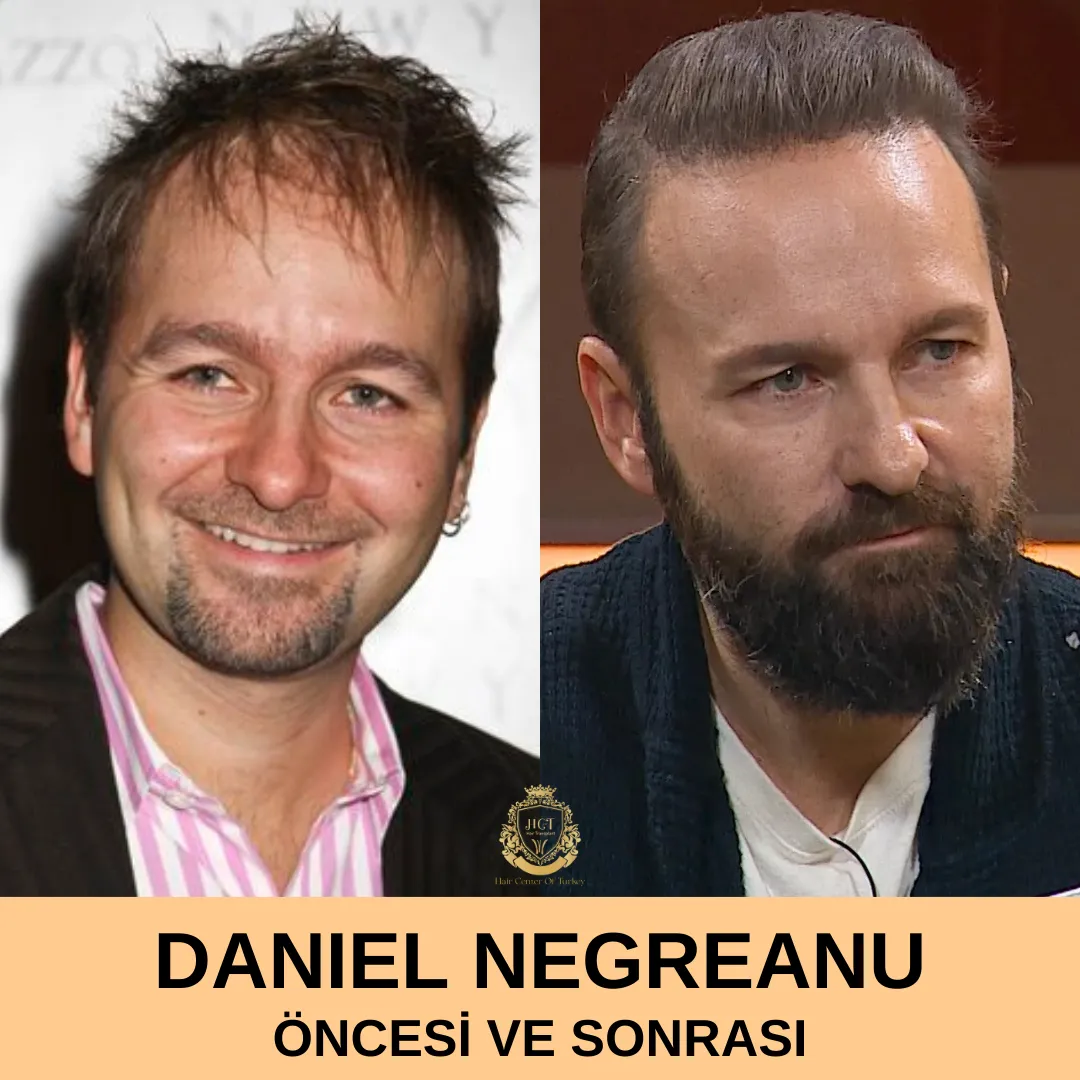 Daniel Negreanu Saç Ekimi