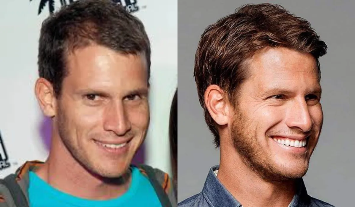 Daniel Tosh Hair Transplant