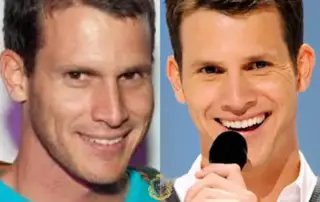 Daniel Tosh Hair Transplant Before and After