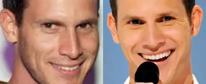 Daniel Tosh Hair Transplant Before and After