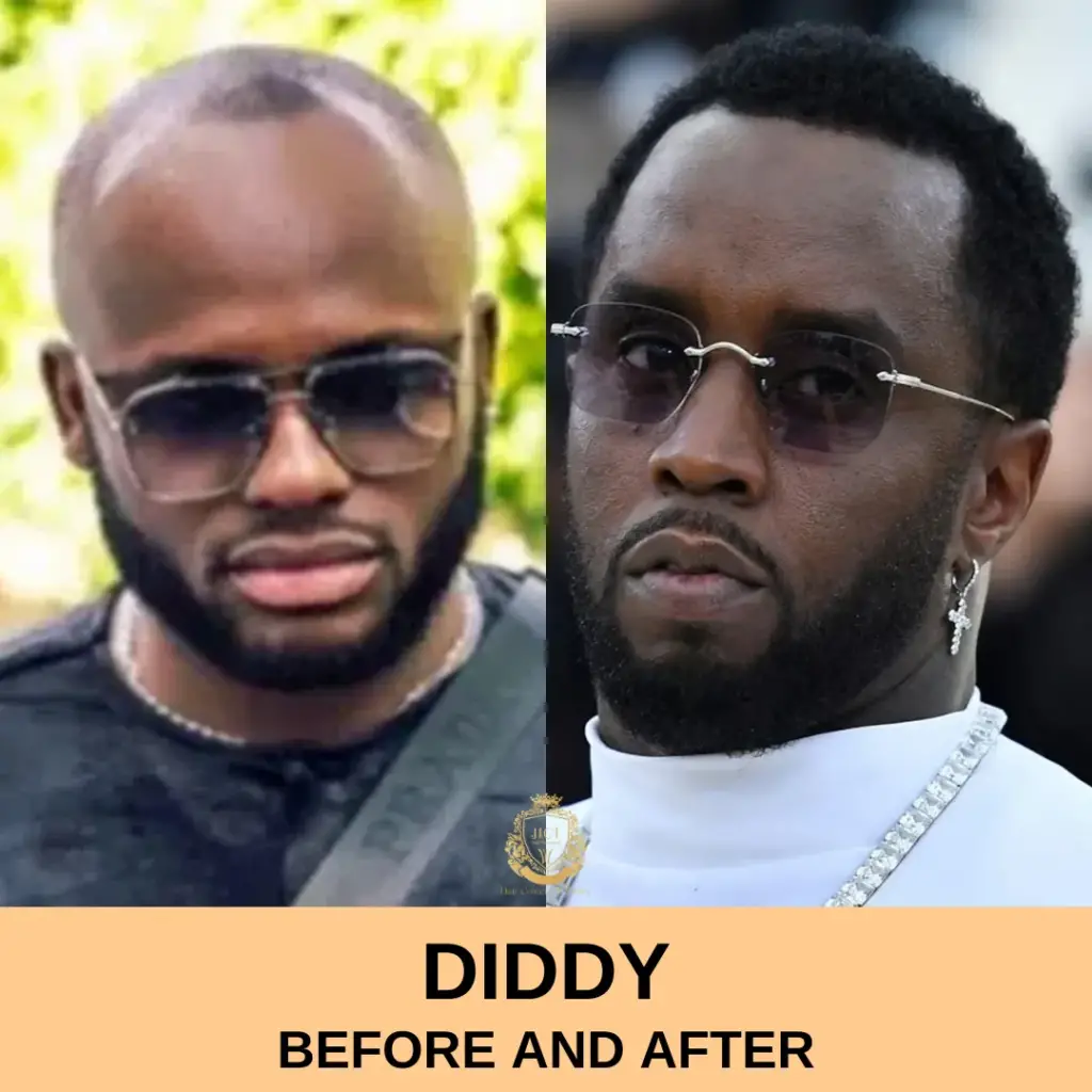 Diddy Hair Transplant