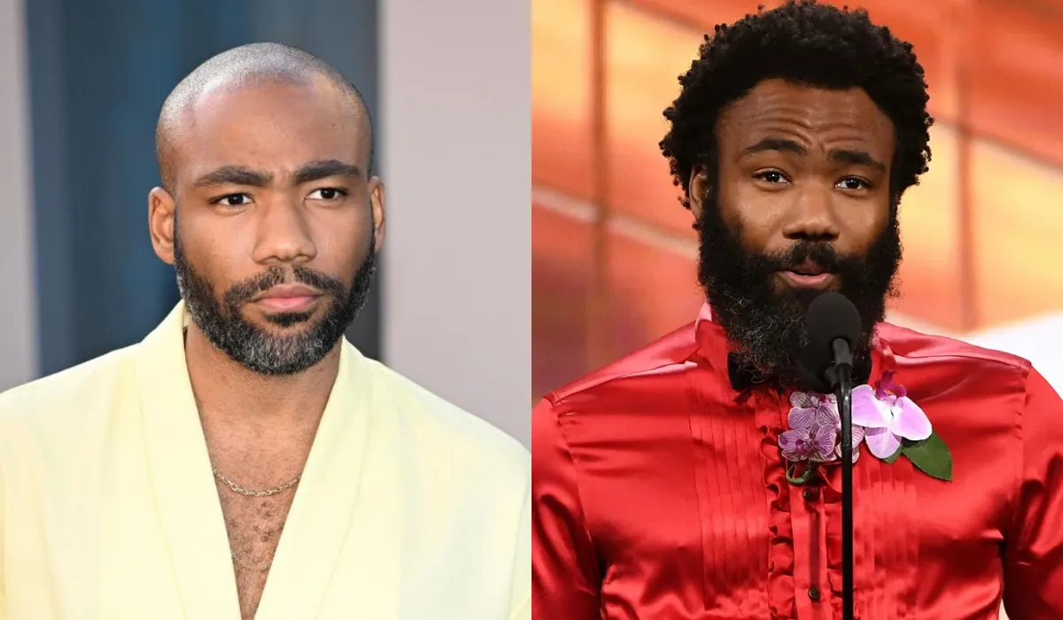 Donald Glover Hair Transplant