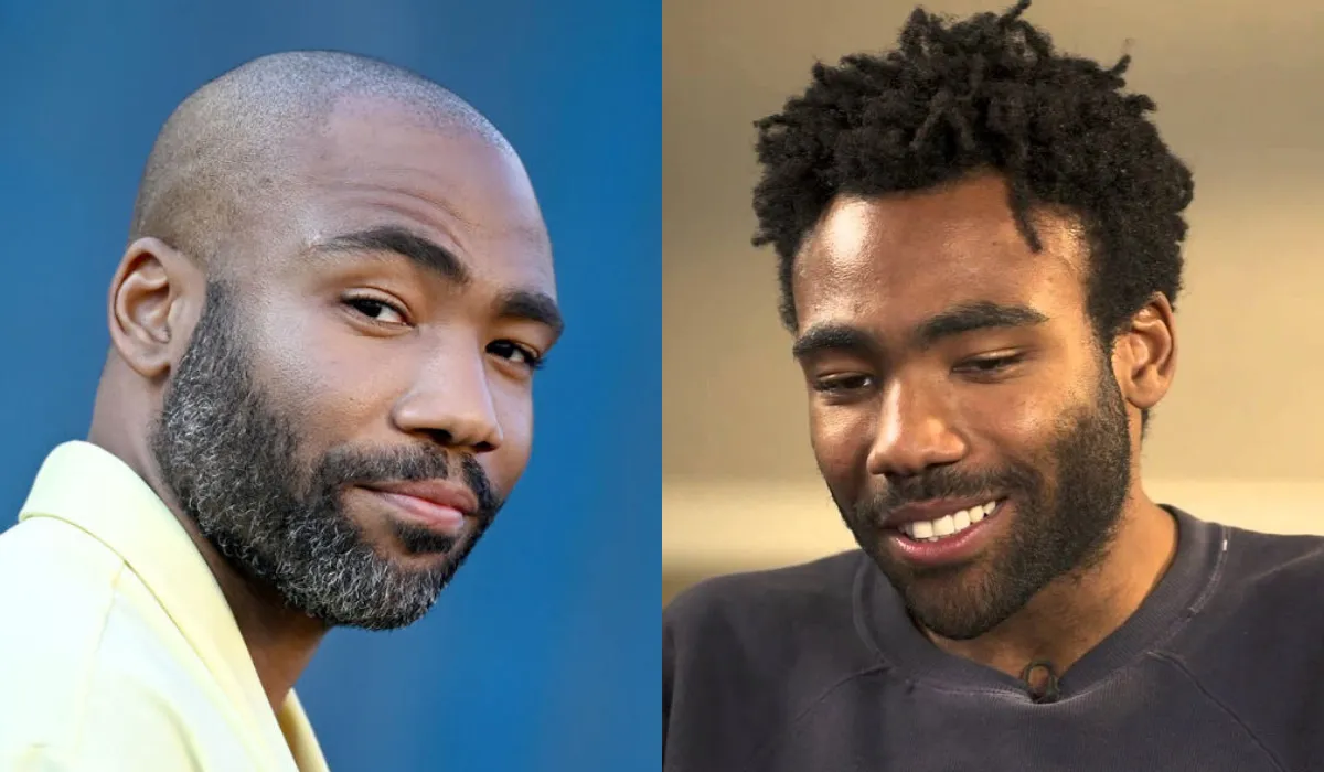 Donald Glover Hair Transplant