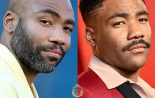 Donald Glover Hair Transplant