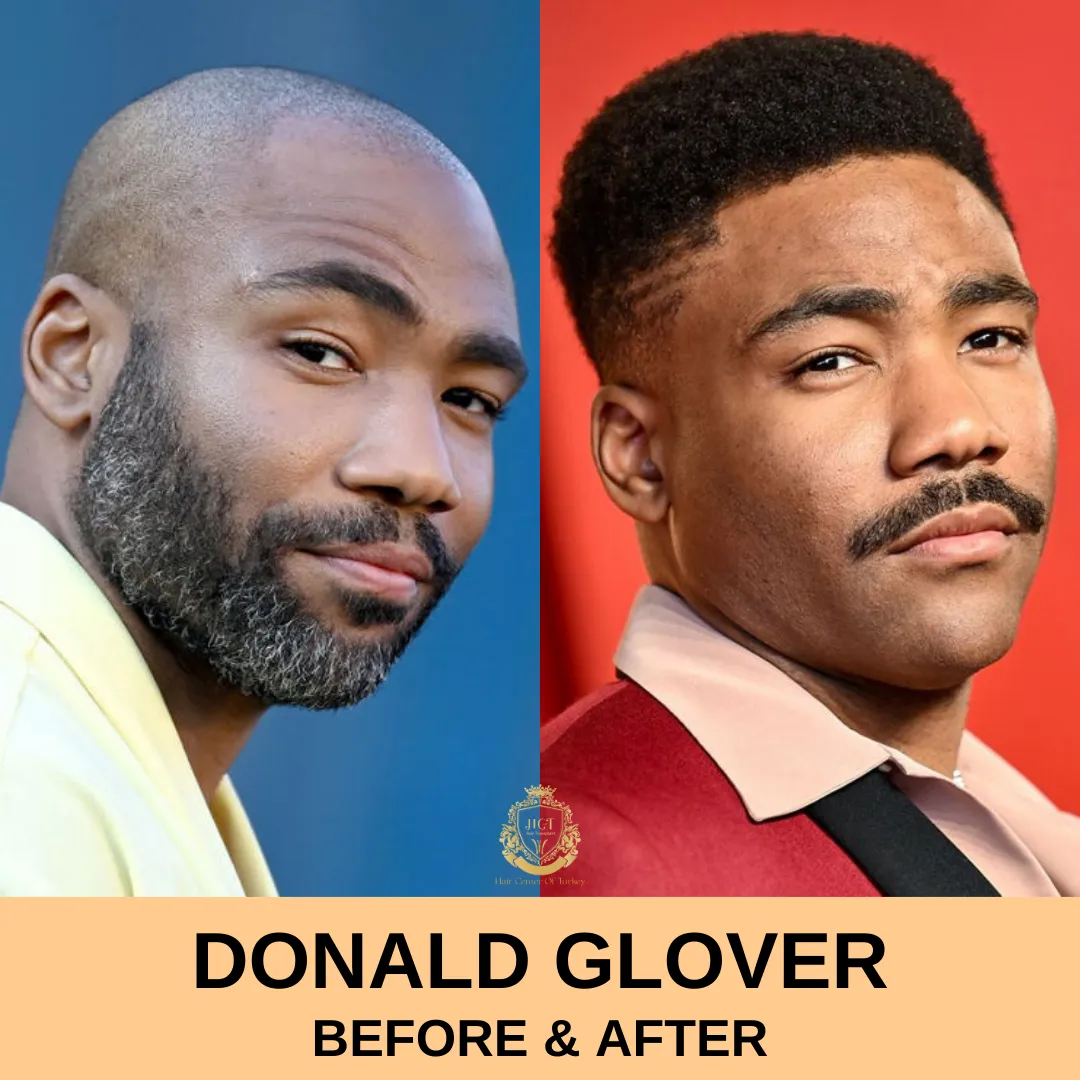 Donald Glover Hair Transplant