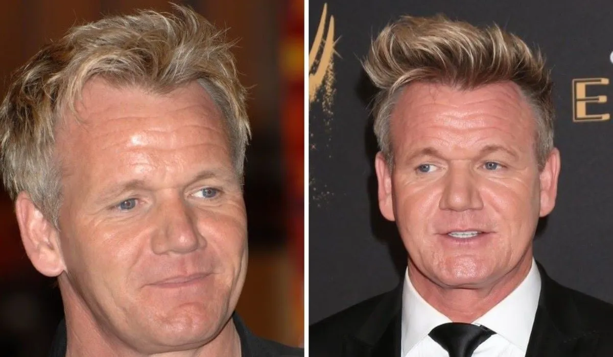 Gordon Ramsay Hair Transplant Before and After