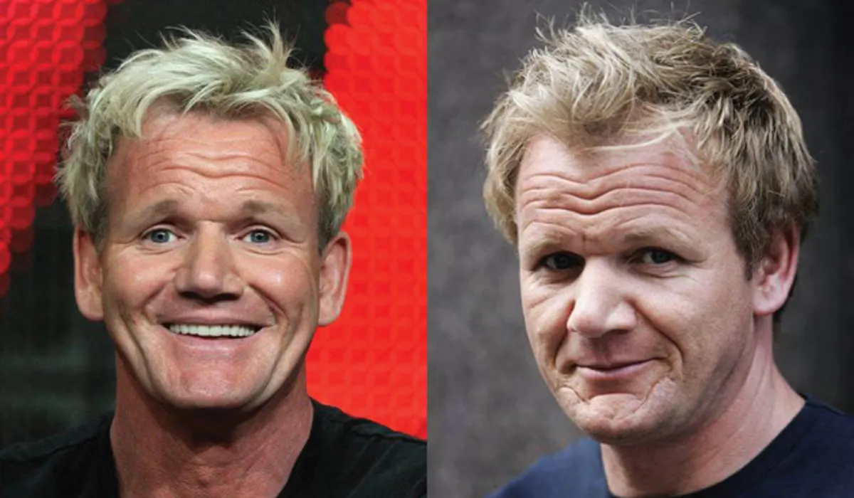 Gordon Ramsay Hair Transplant Before and After