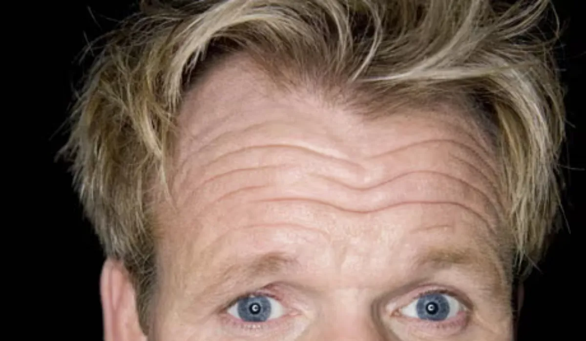 Gordon Ramsay Hair Transplant Before and After