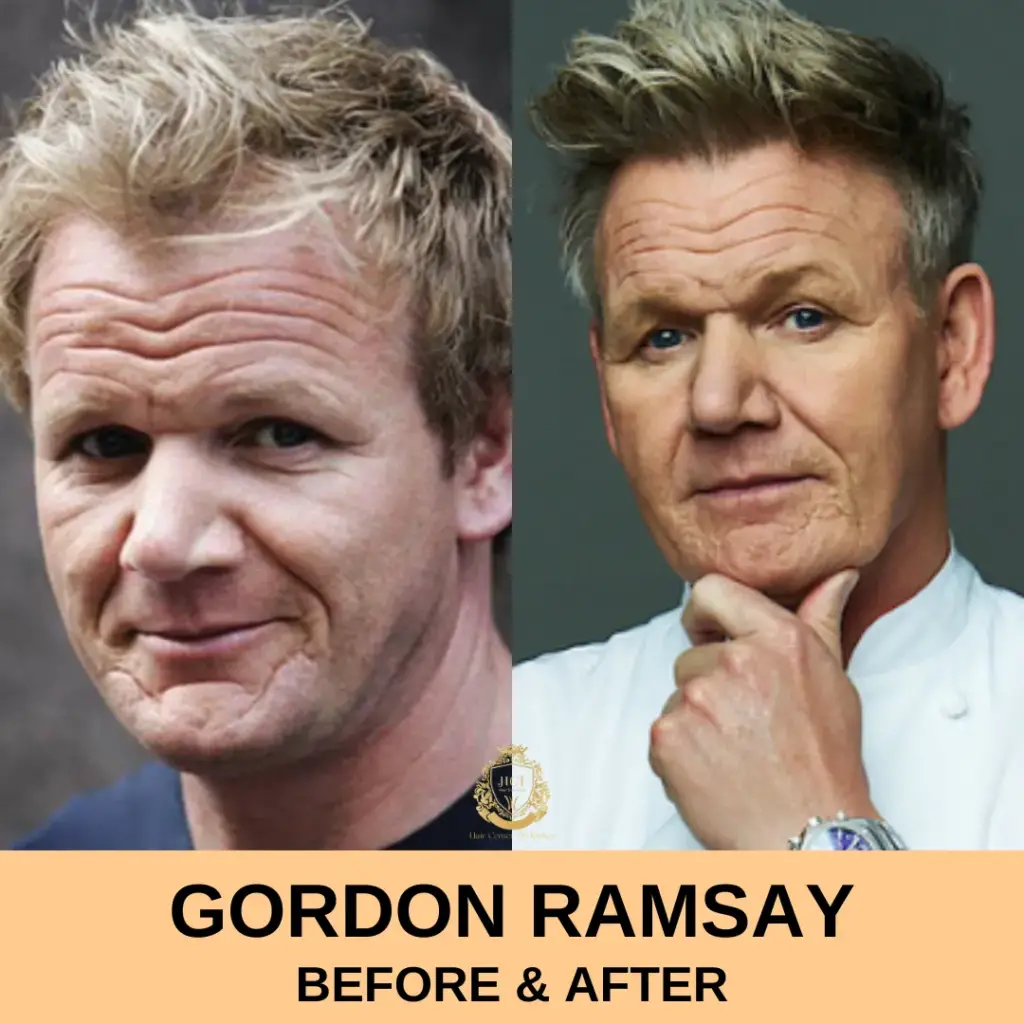 Gordon Ramsay Hair Transplant Before and After