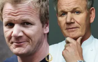 Gordon Ramsay Hair Transplant Before and After