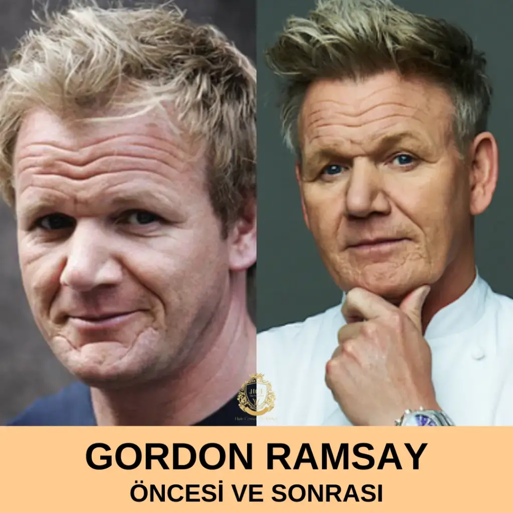 Gordon Ramsay Saç Ekimi Öncesi ve Sonrası