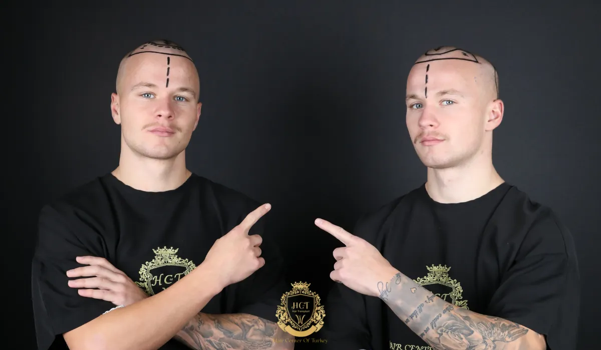 receding hairline