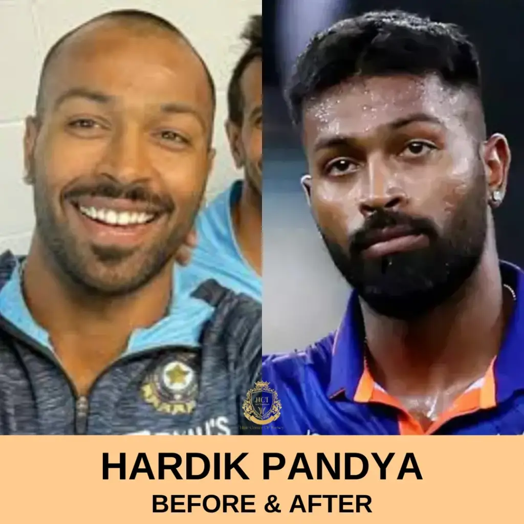 Hardik Pandya Hair Transplant