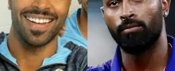 Hardik Pandya Hair Transplant