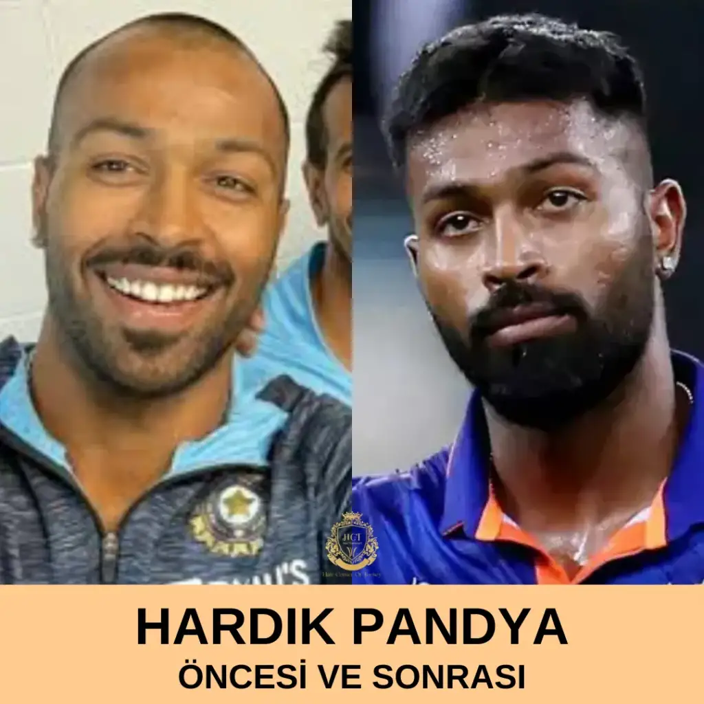 Hardik Pandya Saç Ekimi