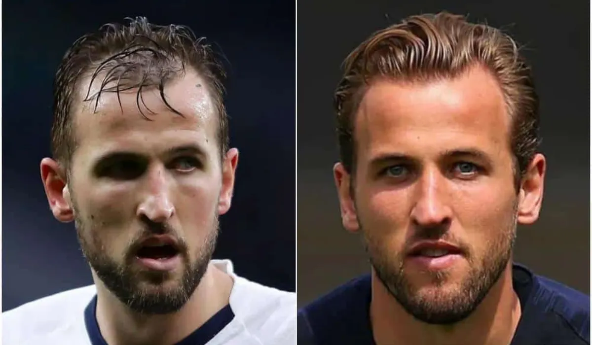 Harry Kane Hair Transplant