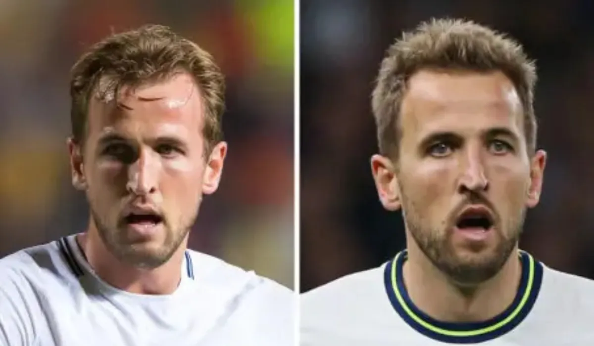 Harry Kane Hair Transplant