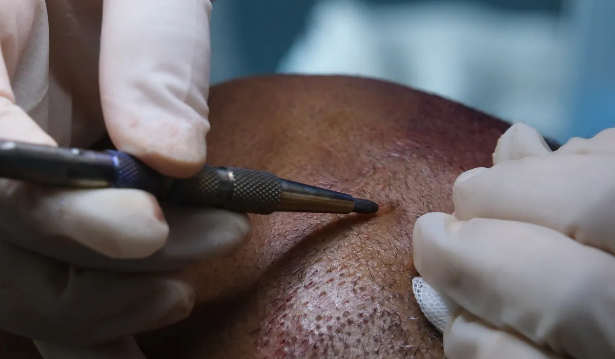 Harry Kane Hair Transplant