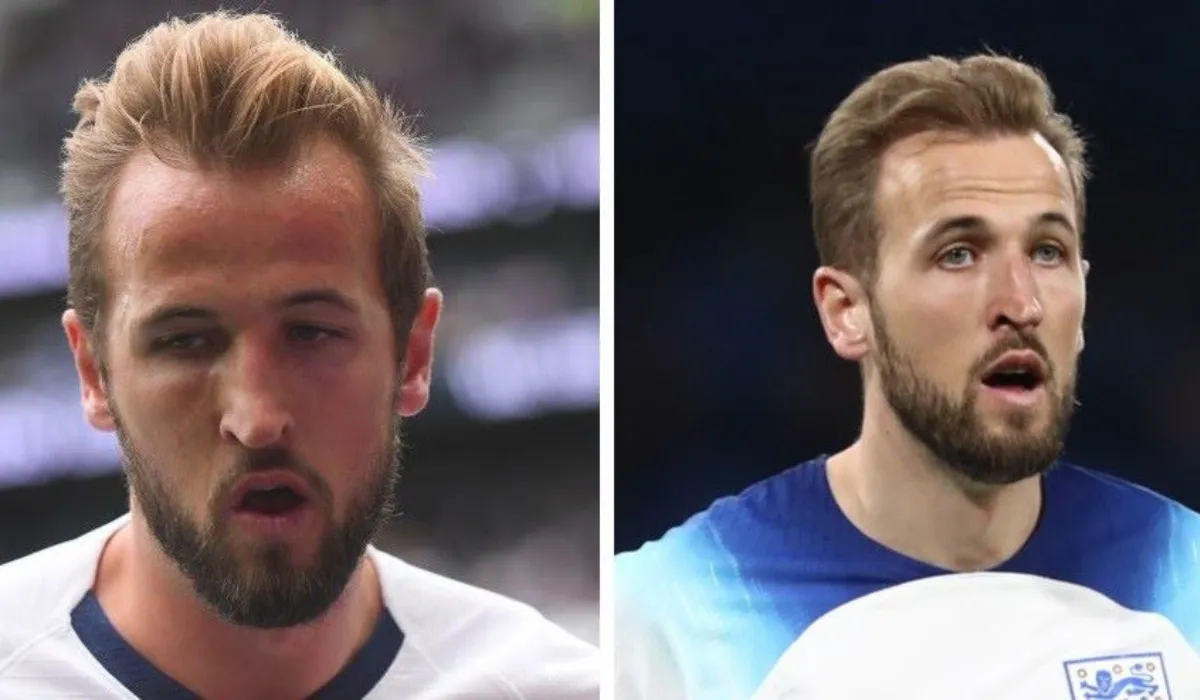 Harry Kane Hair Transplant