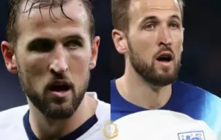 Harry Kane Hair Transplant