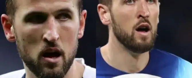 Harry Kane Hair Transplant