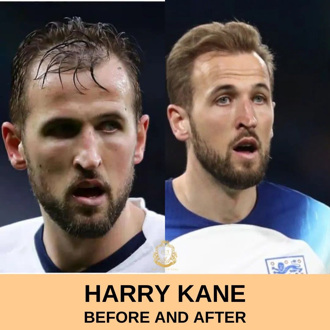 Harry Kane Hair Transplant