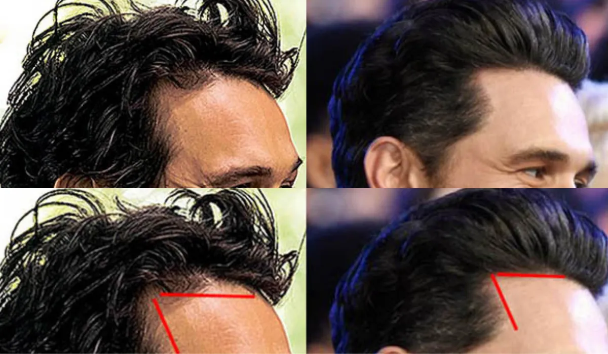 James Franco Hair Transplant