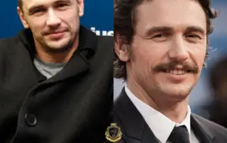 James Franco Hair Transplant