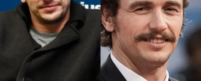 James Franco Hair Transplant