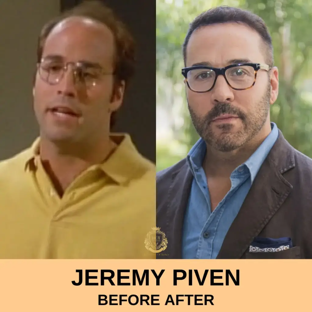 Jeremy Piven Hair Transplant