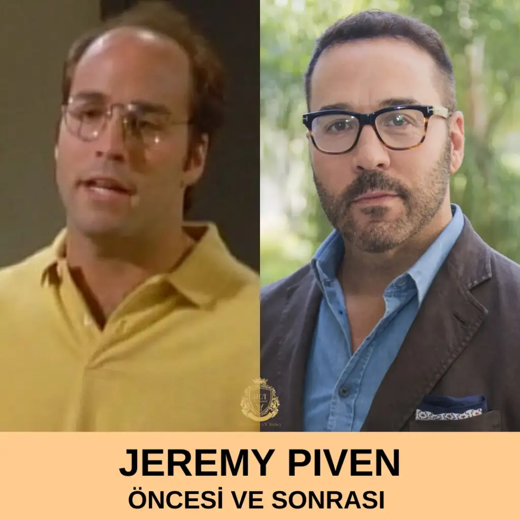 Jeremy Piven Saç Ekimi