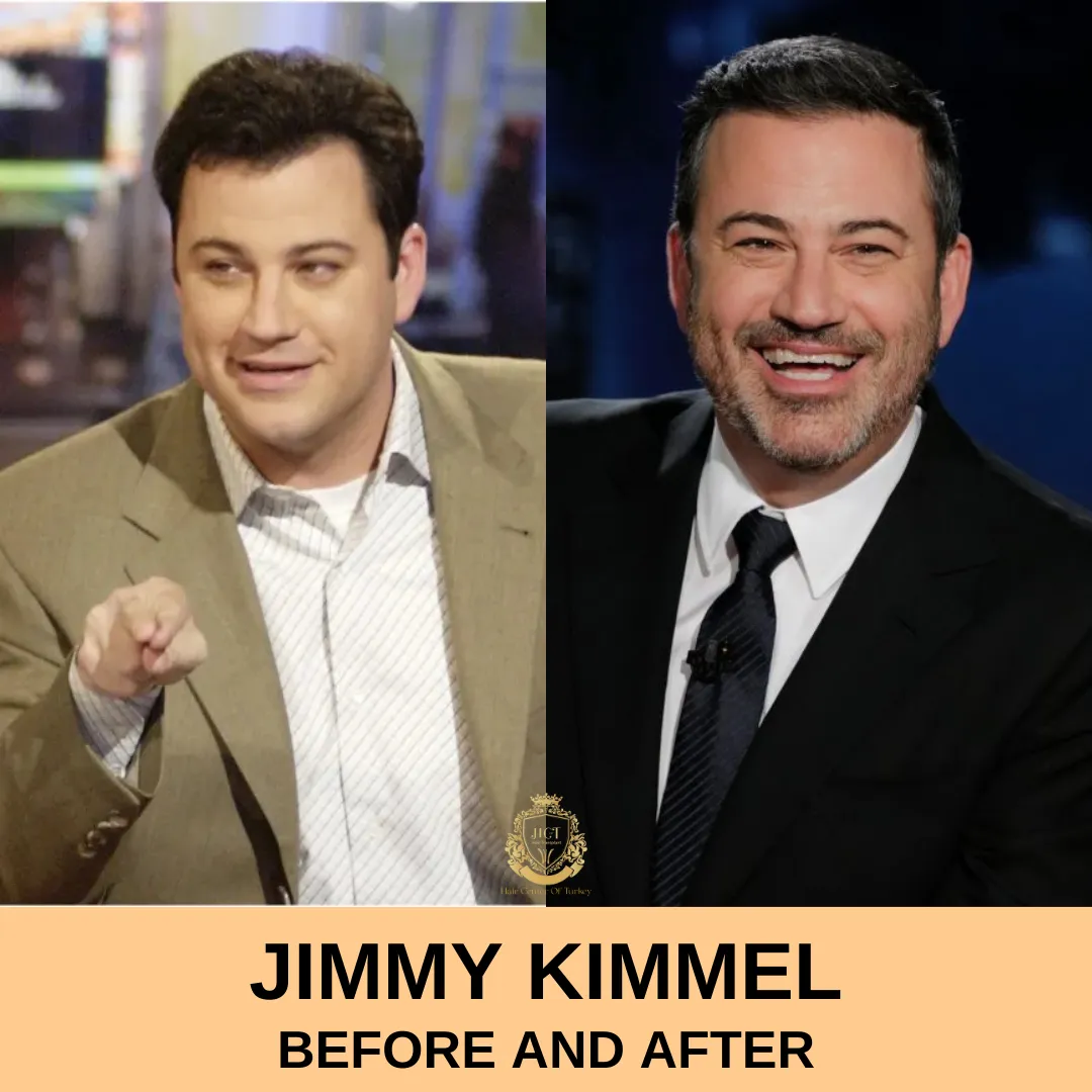 Jimmy Kimmel Hair Transplant