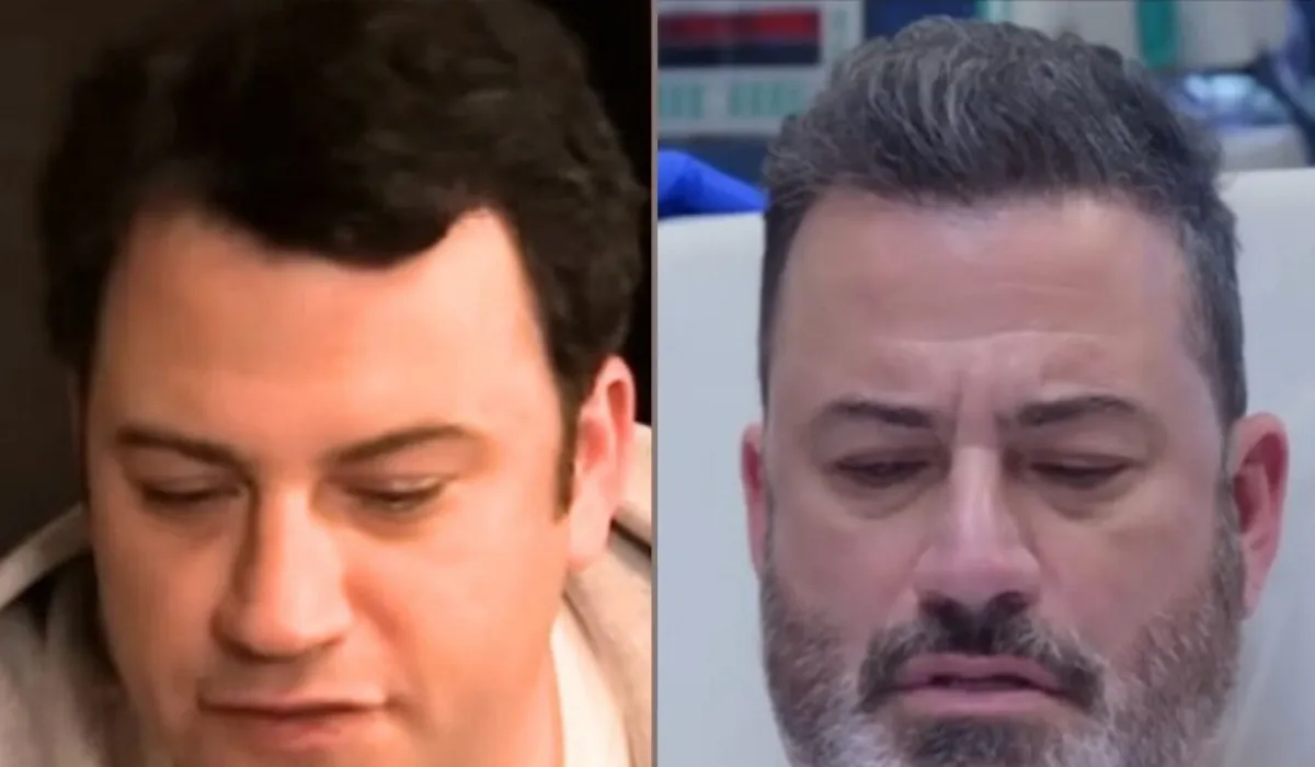 Jimmy Kimmel Hair Transplant